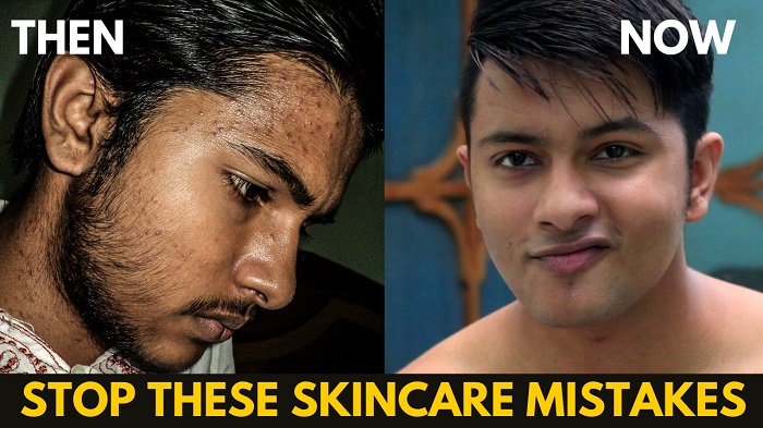 7 SkinCare Mistakes That Causes Acne